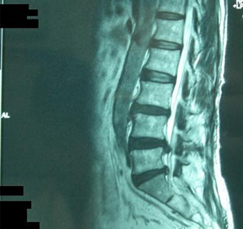 腰部脊柱管狭窄症 腰痛 下肢痛 S24年 男性の場合 望クリニック